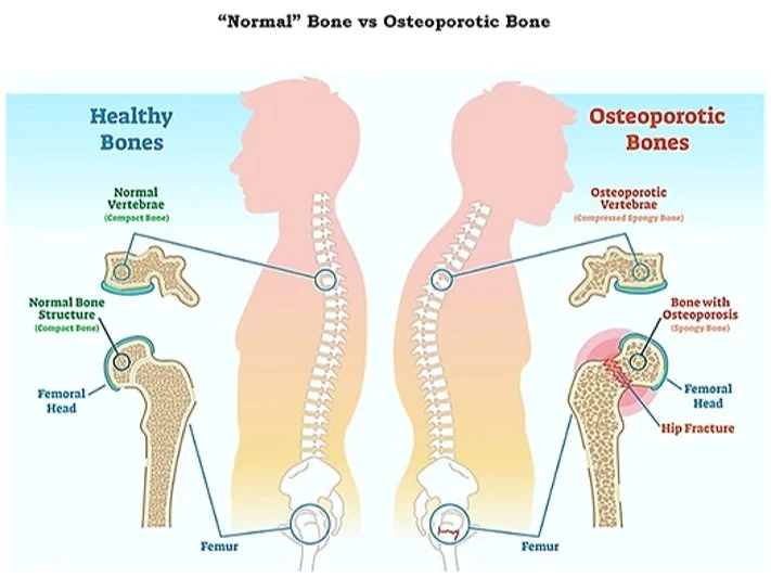Osteoporosis Diagram
